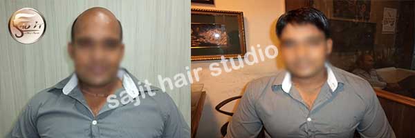 Hair Weaving in Noida, Hair Bonding in Noida, Consult