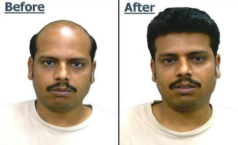 Hair Fixing in Noida, Hair Fixing Clinic in Noida